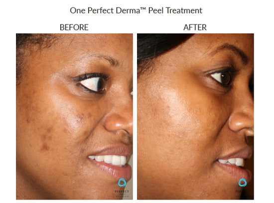 Manufacturer Perfect Derma Peel before-and-after example; results vary; not a LaserTouch MD patient