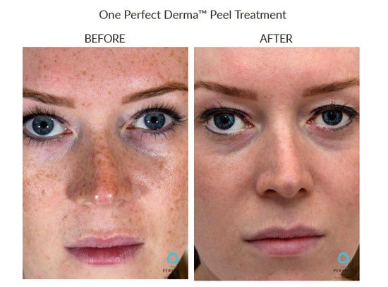 Manufacturer Perfect Derma Peel before-and-after example; results vary; not a LaserTouch MD patient