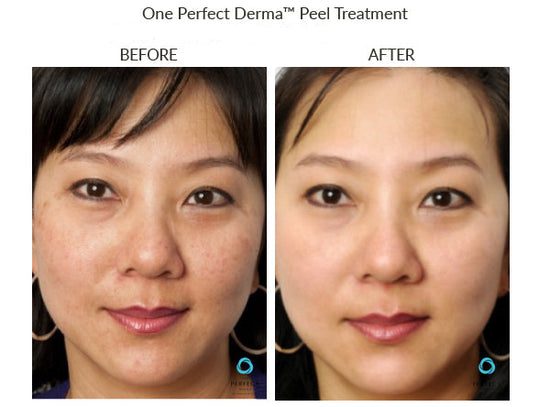 Manufacturer Perfect Derma Peel before-and-after example; results vary; not a LaserTouch MD patient