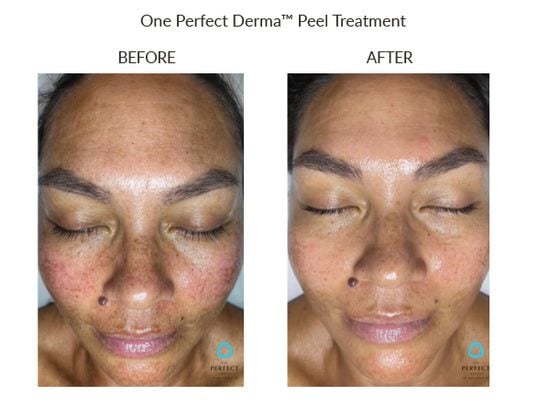 Manufacturer Perfect Derma Peel before-and-after example; results vary; not a LaserTouch MD patient
