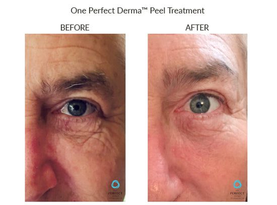 Manufacturer Perfect Derma Peel before-and-after example; results vary; not a LaserTouch MD patient