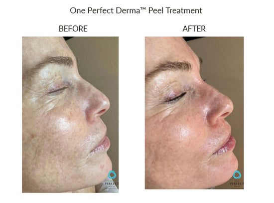 Manufacturer Perfect Derma Peel before-and-after example; results vary; not a LaserTouch MD patient