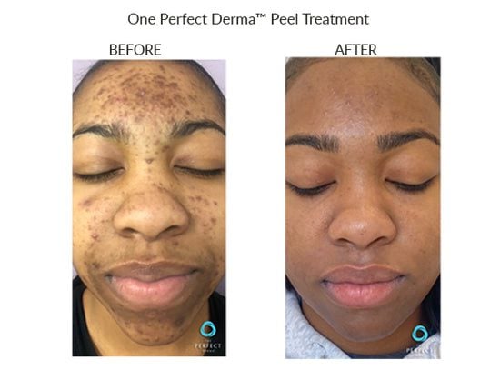 Manufacturer Perfect Derma Peel before-and-after example; results vary; not a LaserTouch MD patient