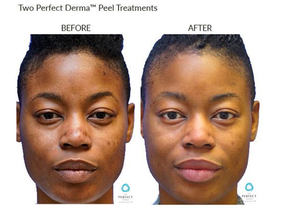 Manufacturer Perfect Derma Peel before-and-after example; results vary; not a LaserTouch MD patient