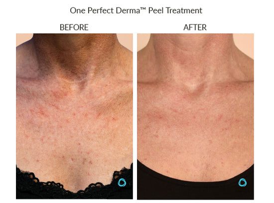 Manufacturer Perfect Derma Peel before-and-after example; results vary; not a LaserTouch MD patient