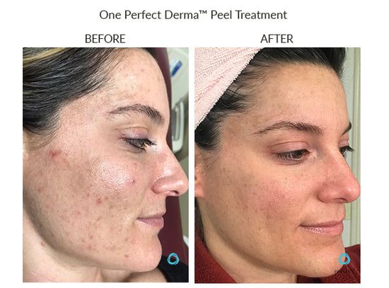 Manufacturer Perfect Derma Peel before-and-after example; results vary; not a LaserTouch MD patient