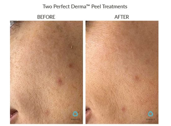 Manufacturer Perfect Derma Peel before-and-after example; results vary; not a LaserTouch MD patient