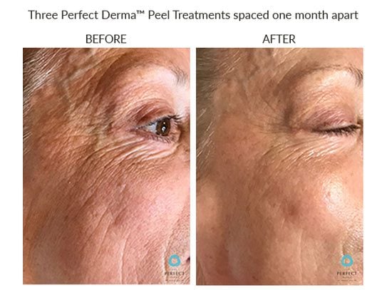Manufacturer Perfect Derma Peel before-and-after example; results vary; not a LaserTouch MD patient